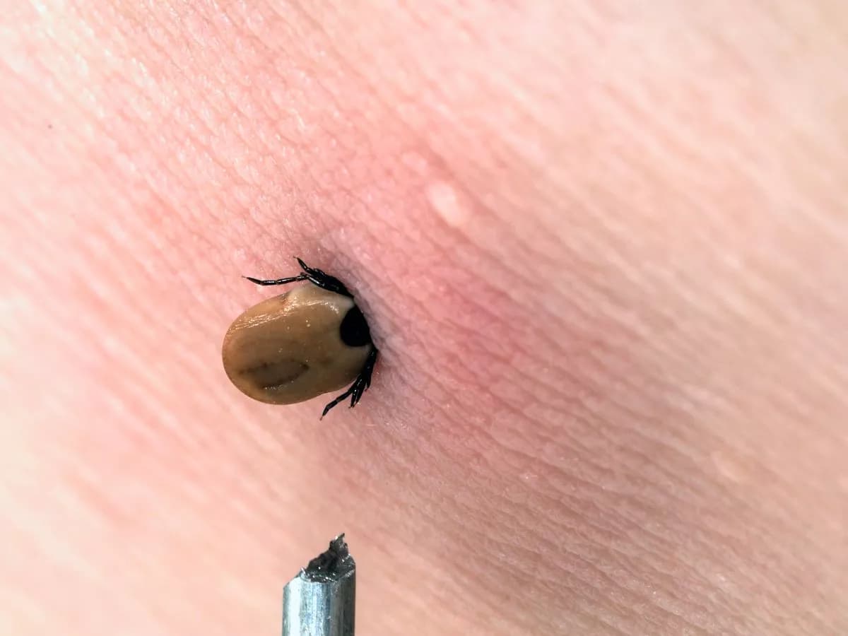 کنه در پوست انسان